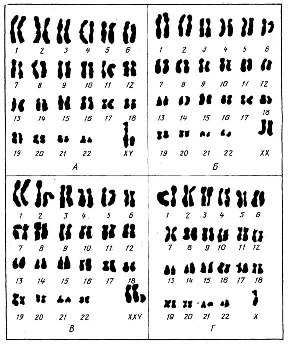Рис. I.4. Хромосомный набор человека: мужской (А), женский (Б), генетические аномалии (В, Г)