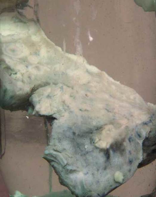 Chronic lung abscess