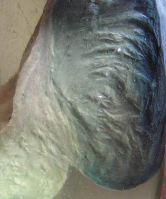 Fibromatous nodule with secondary changes