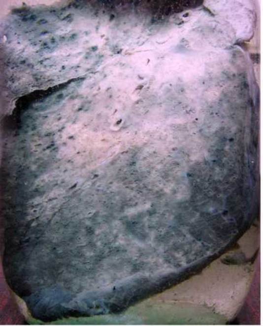 Прикоренева бронхопневмонія