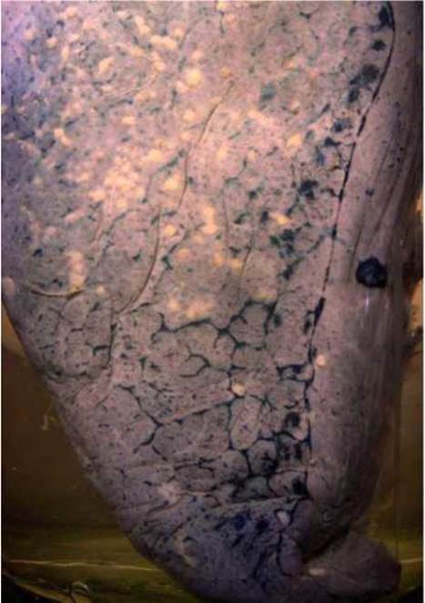 Карциноматоз плеври