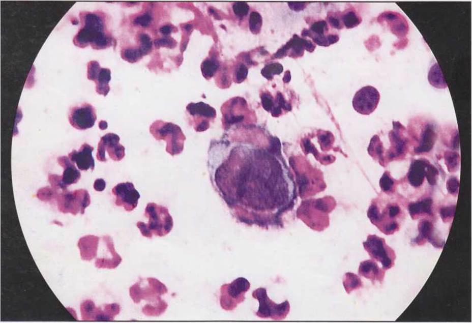 Гигантская многоядерная “вирусная” клетка при генитальном герпесе ...